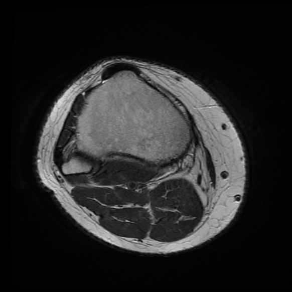 File:Anterior cruciate ligament tear with posteromedial corner injury, bucket-handle meniscal tear and chondral delamination (Radiopaedia 75501-86744 Axial T2 1).jpg