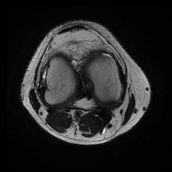 File:Anterior cruciate ligament tear with posteromedial corner injury, bucket-handle meniscal tear and chondral delamination (Radiopaedia 75501-86744 Axial T2 11).jpg