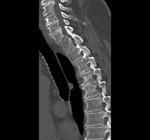 File:Anterior glenohumeral dislocation with Hill-Sachs lesion (Radiopaedia 62877-71249 Sagittal bone window 81).jpg
