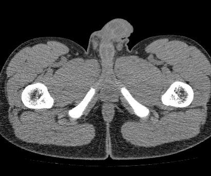 Anterior inferior iliac spine avulsion fracture (Radiopaedia 81312-94999 Axial non-contrast 73).jpg