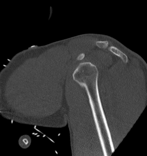 Anterior shoulder dislocation with Hill-Sachs and bony Bankart lesions (Radiopaedia 40424-42974 Sagittal bone window 18).png