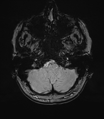 File:Anterior temporal lobe perivascular space (Radiopaedia 40946-43650 Axial SWI 13).png