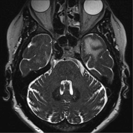 Anterior temporal pole cysts (Radiopaedia 46629-51102 Axial 17).png