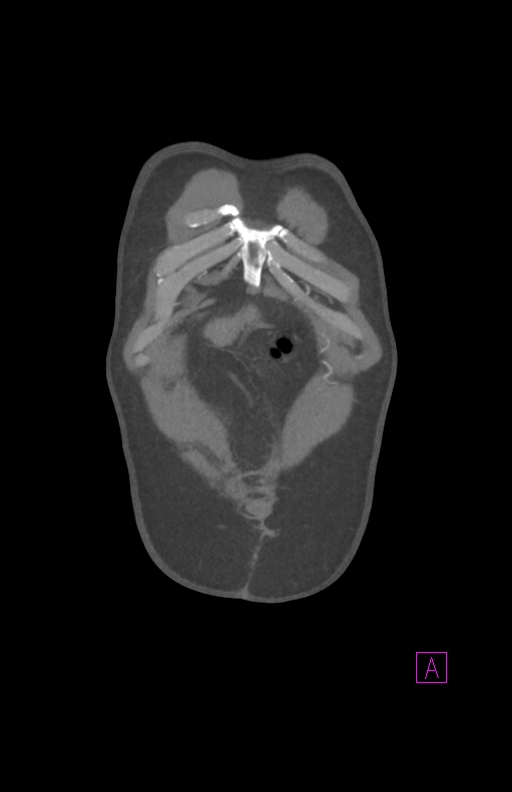Aortectomy and axillary-bifemoral bypass (Radiopaedia 28303-28545 C 10).jpg