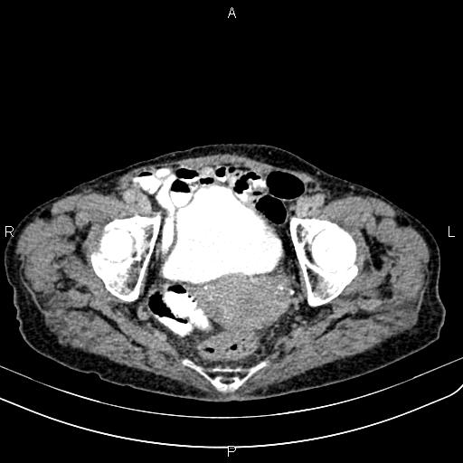 Aortic aneurysm and Lemmel syndrome (Radiopaedia 86499-102554 Axial C+ delayed 71).jpg