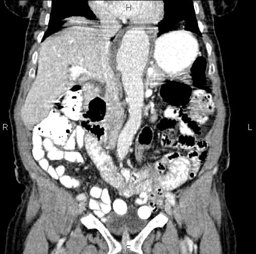 File:Aortic aneurysm and Lemmel syndrome (Radiopaedia 86499-102554 C 25).jpg