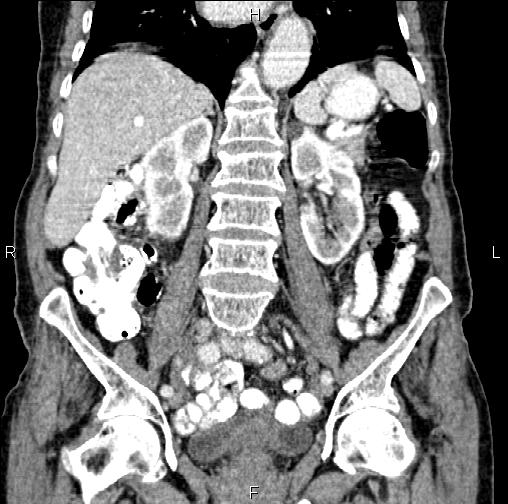 Aortic aneurysm and Lemmel syndrome (Radiopaedia 86499-102554 C 36).jpg