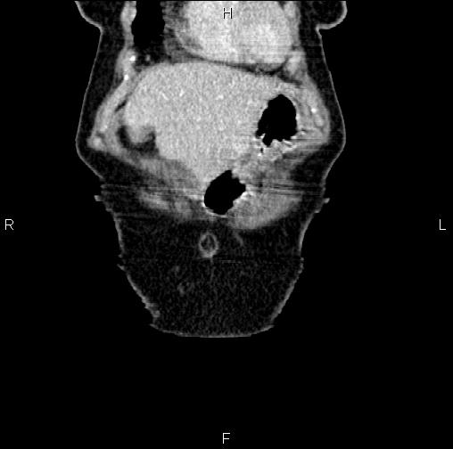Aortic aneurysm and Lemmel syndrome (Radiopaedia 86499-102554 C 4).jpg