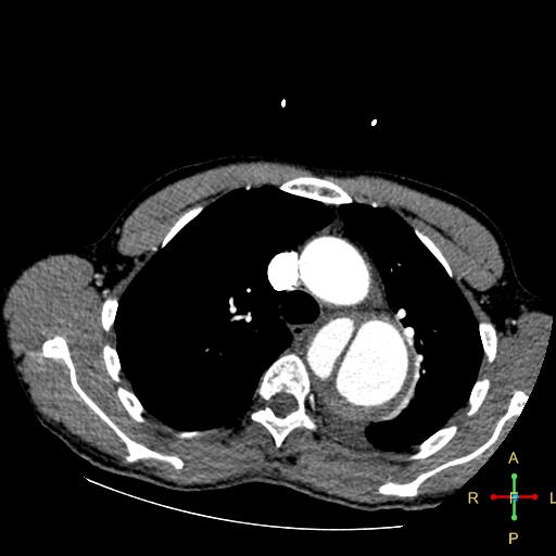 File:Aortic aneurysm and penetrating ulcer (Radiopaedia 23590-23704 A 10).jpg