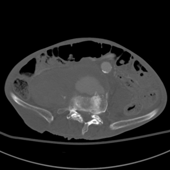 Aortic aneurysm with spinal destruction (Radiopaedia 42301-45410 Axial bone window 66).jpg