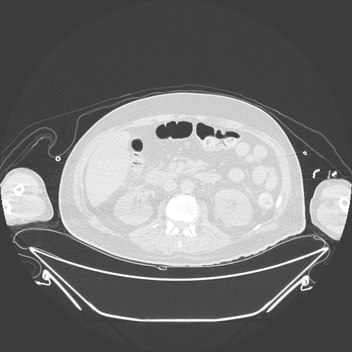 Aortic arch aneurysm (Radiopaedia 84109-99365 Axial lung window 346).jpg