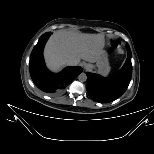 Aortic arch aneurysm (Radiopaedia 84109-99365 Axial non-contrast 241).jpg