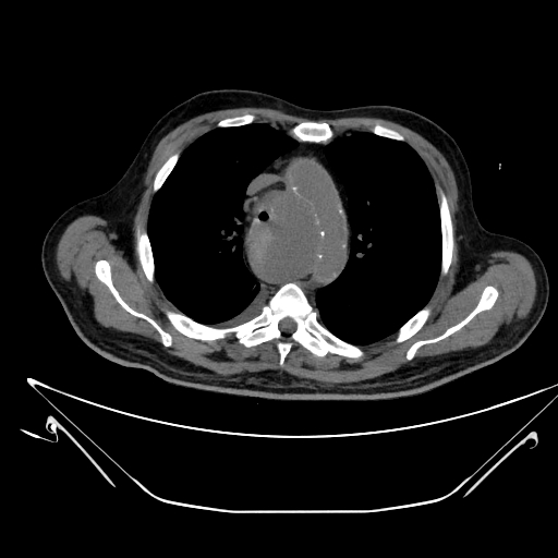 Aortic arch aneurysm (Radiopaedia 84109-99365 Axial non-contrast 98).jpg