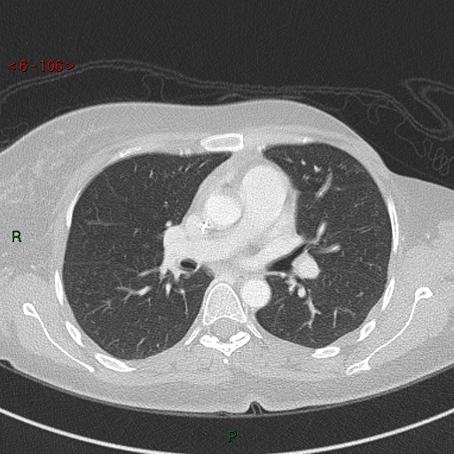 Aortic arch origin of left vertebral artery (Radiopaedia 51520-57286 Axial lung window 106).jpg