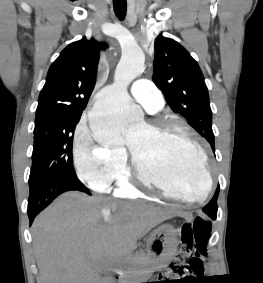File:Aortic coarctation with aneurysm (Radiopaedia 74818-85828 C 44).jpg