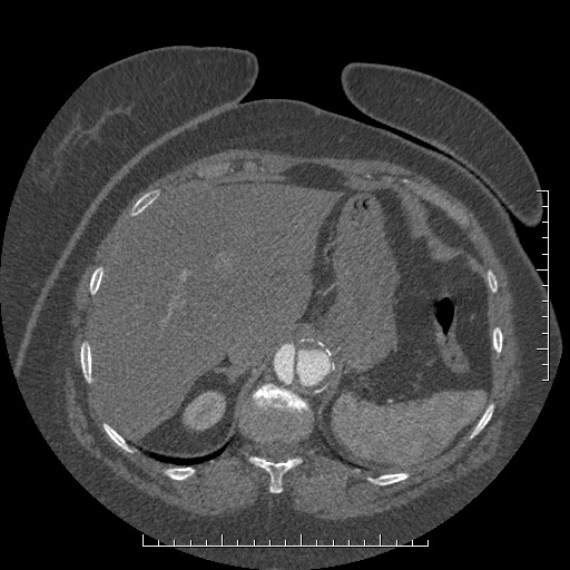 File:Aortic dissection- Stanford A (Radiopaedia 35729-37268 B 28).jpg
