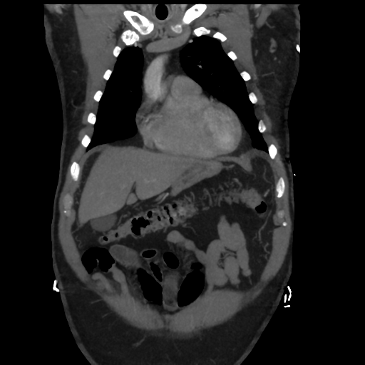 File:Aortic dissection- Stanford A (Radiopaedia 37759-39664 Coronal C+ delayed 8).png