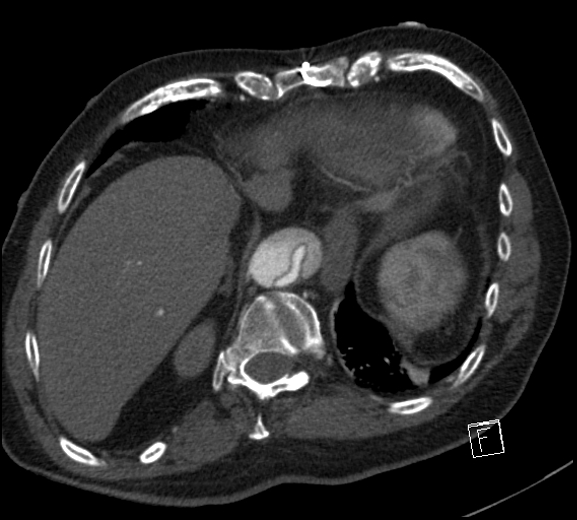 Aortic dissection (CTPA) (Radiopaedia 75506-86750 A 77).jpg