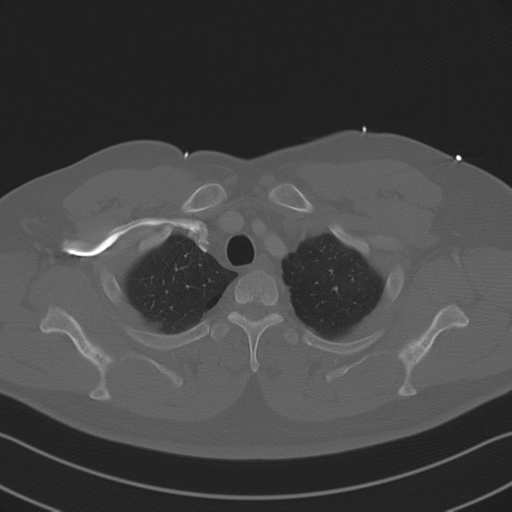 File:Aortic dissection (Radiopaedia 50763-56234 Axial bone window 21).png
