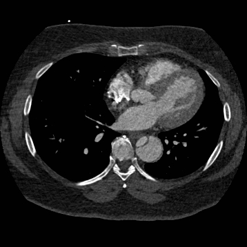 File:Aortic dissection (Radiopaedia 57969-64959 A 191).jpg