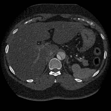 Aortic dissection (Radiopaedia 57969-64959 A 311).jpg