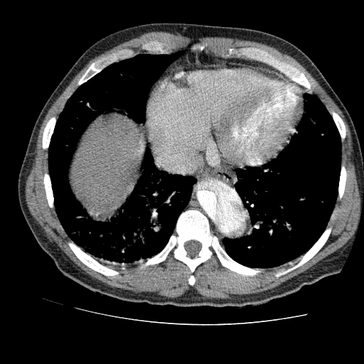 File:Aortic dissection - Stanford A -DeBakey I (Radiopaedia 28339-28587 B 75).jpg