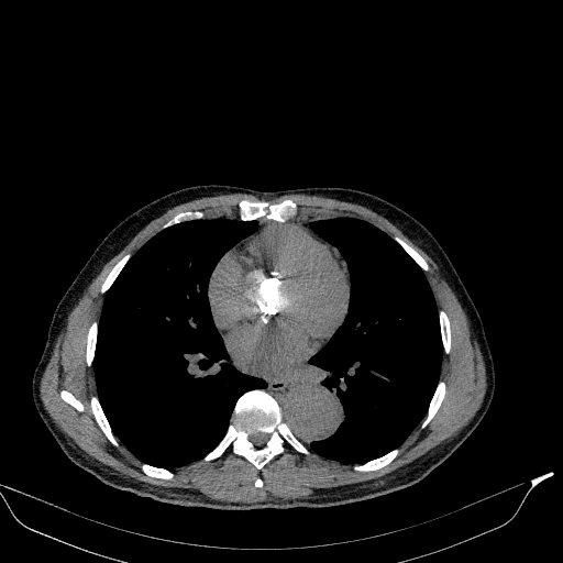 Aortic dissection - Stanford type A (Radiopaedia 83418-98500 Axial non-contrast 25).jpg