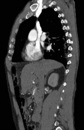 File:Aortic dissection - Stanford type B (Radiopaedia 73648-84437 C 95).jpg