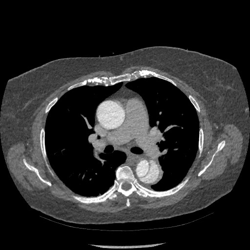 Aortic dissection - Stanford type B (Radiopaedia 88281-104910 A 34).jpg