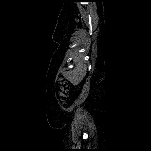 Aortic dissection - Stanford type B (Radiopaedia 88281-104910 C 5).jpg