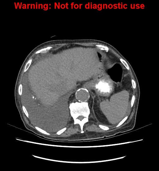 Aortic graft infection (Radiopaedia 44979-48907 Axial non-contrast 23).jpg