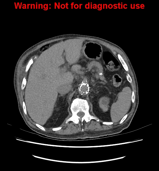Aortic graft infection (Radiopaedia 44979-48907 Axial non-contrast 34).jpg