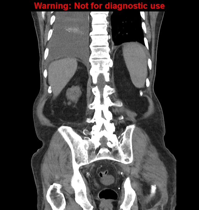 Aortic graft infection (Radiopaedia 44979-48907 non-contrast 39).jpg