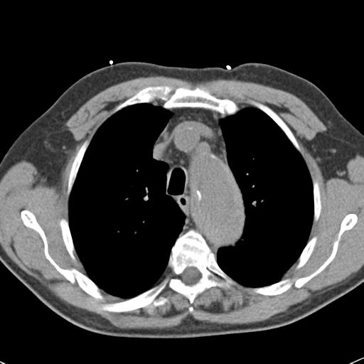 Aortic intramural hematoma (Radiopaedia 31139-31838 Axial non-contrast 16).jpg