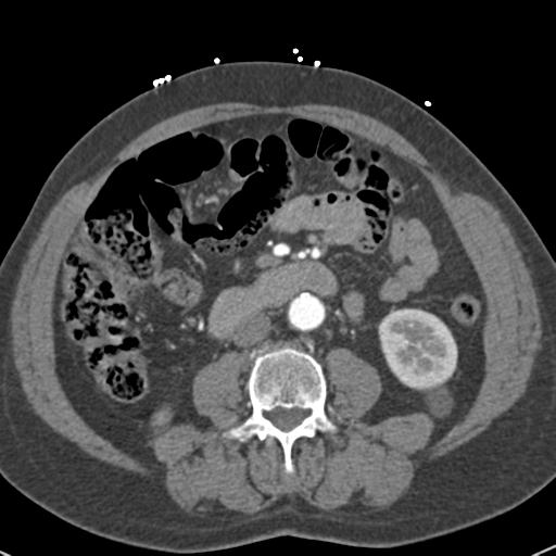 Aortic intramural hematoma (Radiopaedia 31139-31838 B 110).jpg