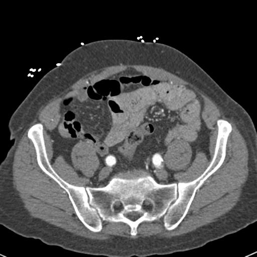 Aortic intramural hematoma (Radiopaedia 31139-31838 B 138).jpg