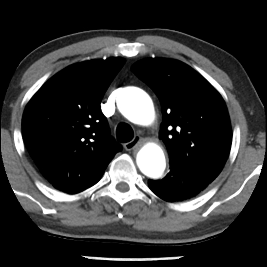 File:Aortic intramural hematoma (type B) (Radiopaedia 79323-92387 B 16).jpg