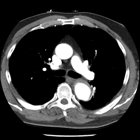 File:Aortic intramural hematoma (type B) (Radiopaedia 79323-92387 B 21).jpg