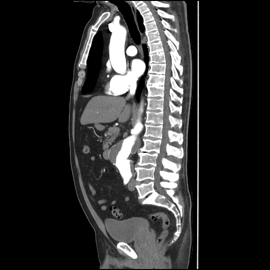 Aortic intramural hematoma (type B) (Radiopaedia 79323-92387 H 24).jpg