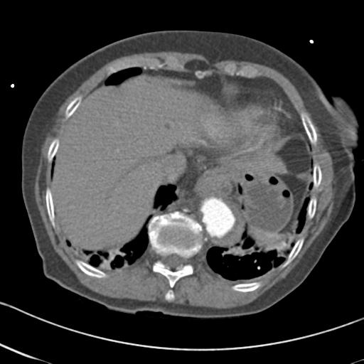 Aortic intramural hematoma from penetrating atherosclerotic ulcer (Radiopaedia 31137-31836 A 65).jpg