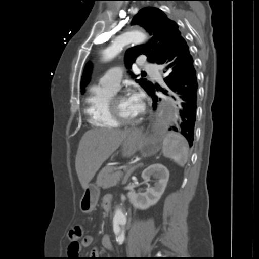 File:Aortic intramural hematoma from penetrating atherosclerotic ulcer (Radiopaedia 31137-31836 B 10).jpg