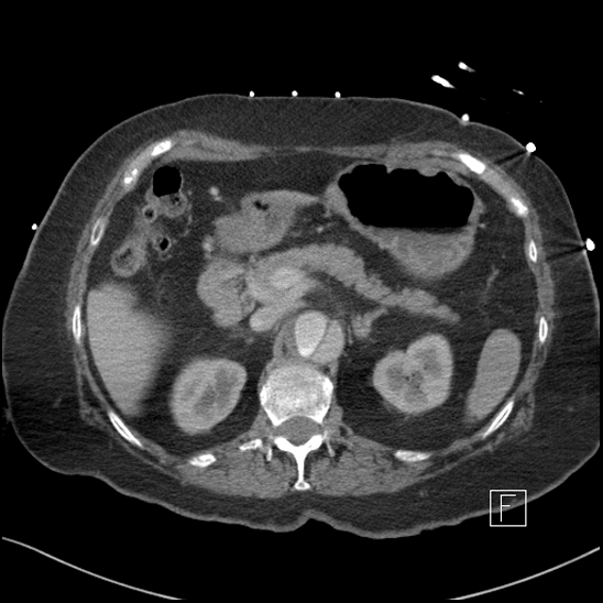 File:Aortic intramural hematoma with dissection and intramural blood pool (Radiopaedia 77373-89491 E 17).jpg