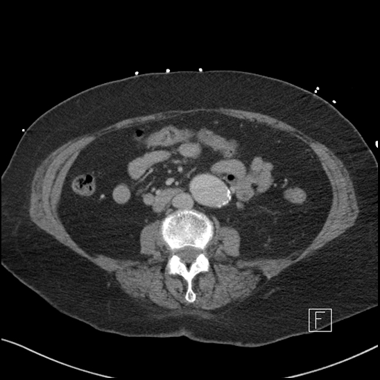 File:Aortic intramural hematoma with dissection and intramural blood pool (Radiopaedia 77373-89491 E 43).jpg