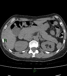 File:Aortic valve endocarditis (Radiopaedia 87209-103485 Axial non-contrast 102).jpg