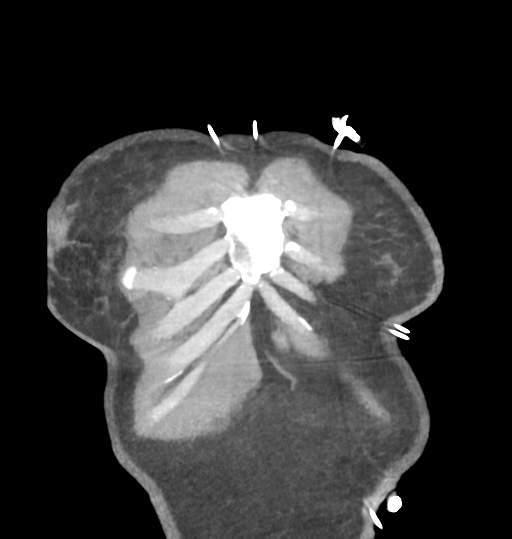 Aortic valve non-coronary cusp thrombus (Radiopaedia 55661-62189 C 8).png
