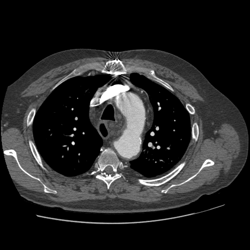 File:Aorto-coronary bypass graft aneurysms (Radiopaedia 40562-43157 A 33).png