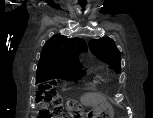 Aortoesophageal fistula with endovascular repair (Radiopaedia 73781-84592 Coronal C+ CTPA 19).jpg