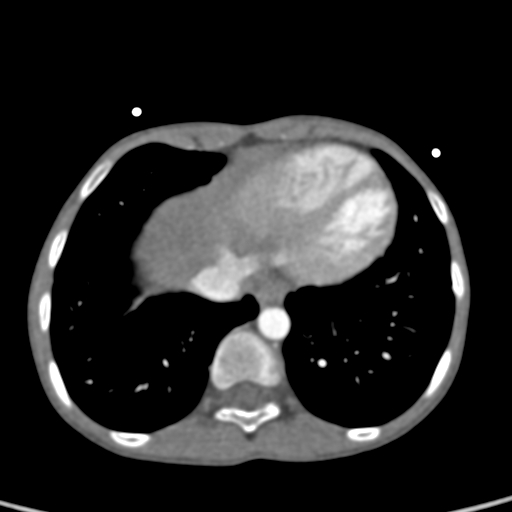 File:Aortopulmonary window, interrupted aortic arch and large PDA giving the descending aorta (Radiopaedia 35573-37074 B 74).jpg