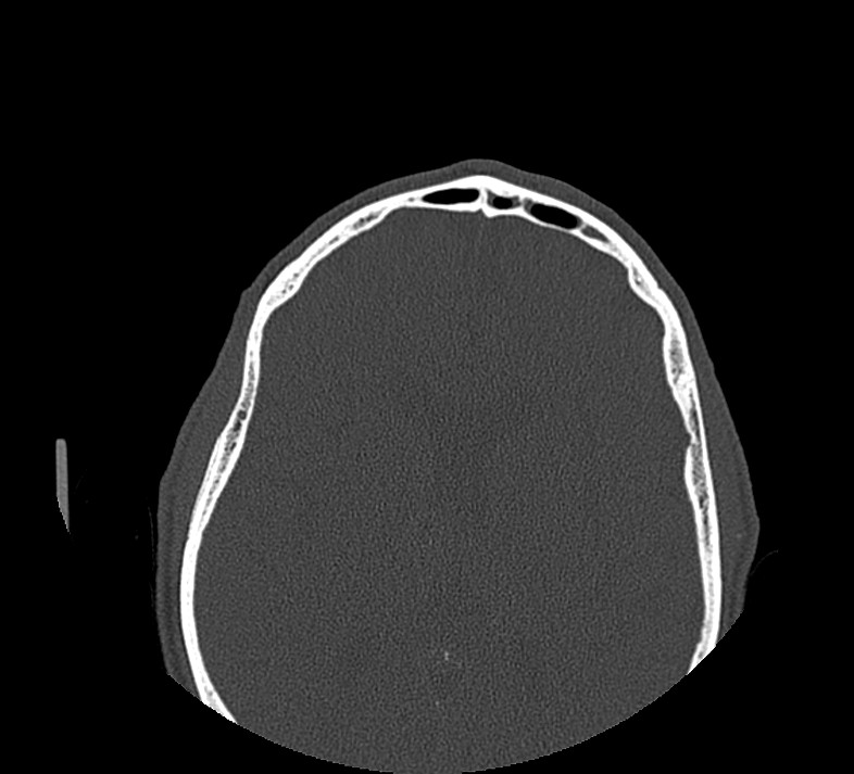 Aplastic maxillary sinuses (Radiopaedia 60030-67561 Axial non-contrast 72).jpg