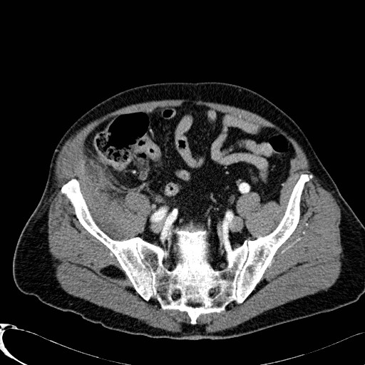 Appendiceal adenocarcinoma complicated by retroperitoneal abscess (Radiopaedia 58007-65039 B 109).jpg